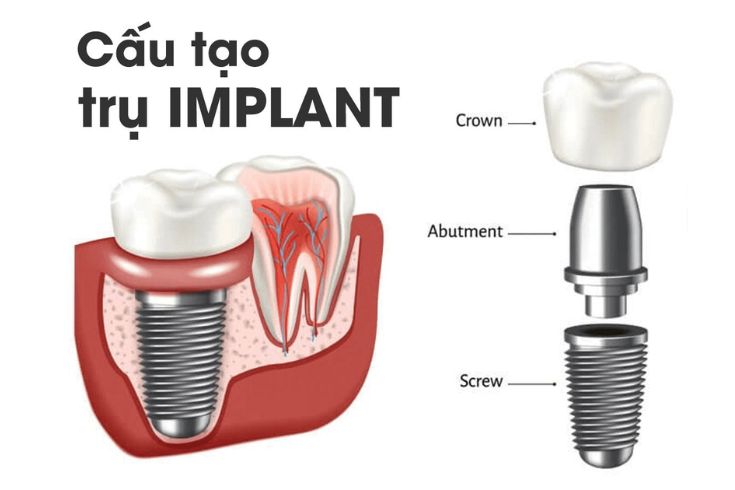 cay-ghep-implant-giai-phap-cay-ghep-implant-hoan-hao-cho-nu-cuoi-2.jpg