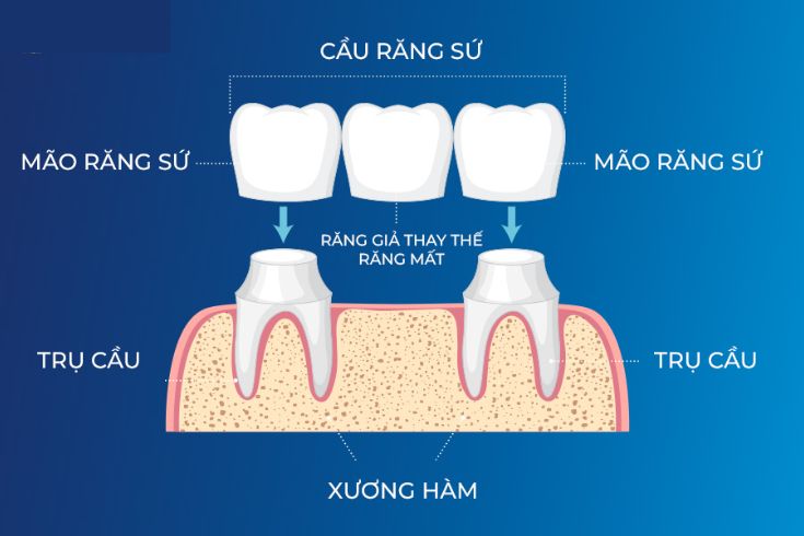 cay-ghep-implant-o-tre-em-kien-thuc-nha-khoa-cay-ghep-implant-tu-a-z-9.jpg