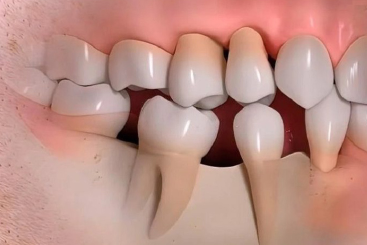 khuyen-cao-chuyen-gia-truong-hop-khong-nen-trong-rang-implant-4.jpg