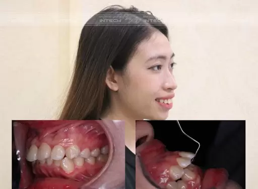 nieng-rang-ho-giai-phap-toi-uu-cho-nu-cuoi-hoan-hao-4.webp