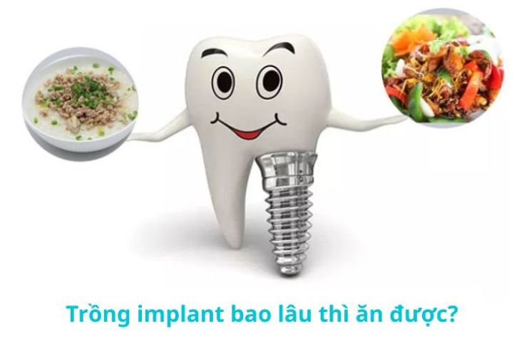 thoi-gian-an-duoc-sau-khi-trong-rang-implant-2.jpg