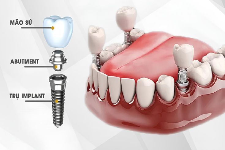 trong-rang-implant-giai-phap-hoan-hao-tu-tin-cho-nu-cuoi-2.jpg