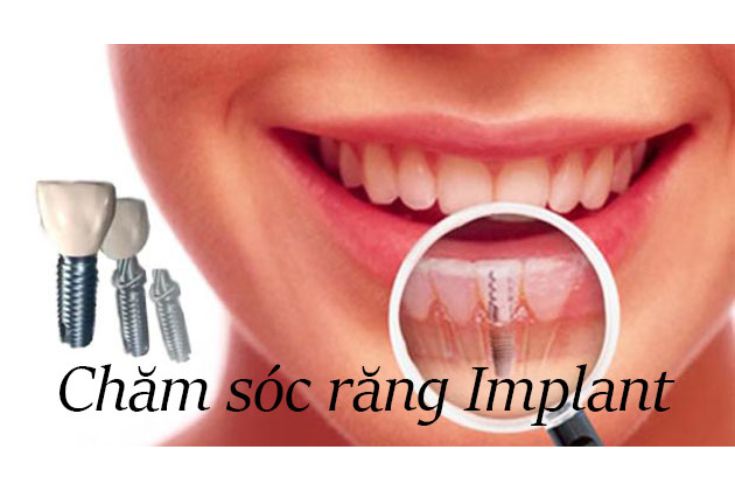 trong-rang-implant-va-cay-ghep-implant-diem-khac-biet-va-su-lua-chon-phu-hop-6.jpg